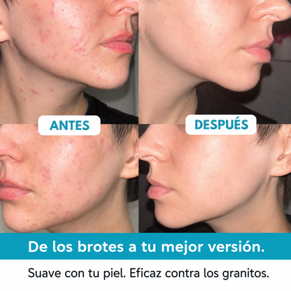 DermaSeal™ - Parche Anti-Granos en Rollo
